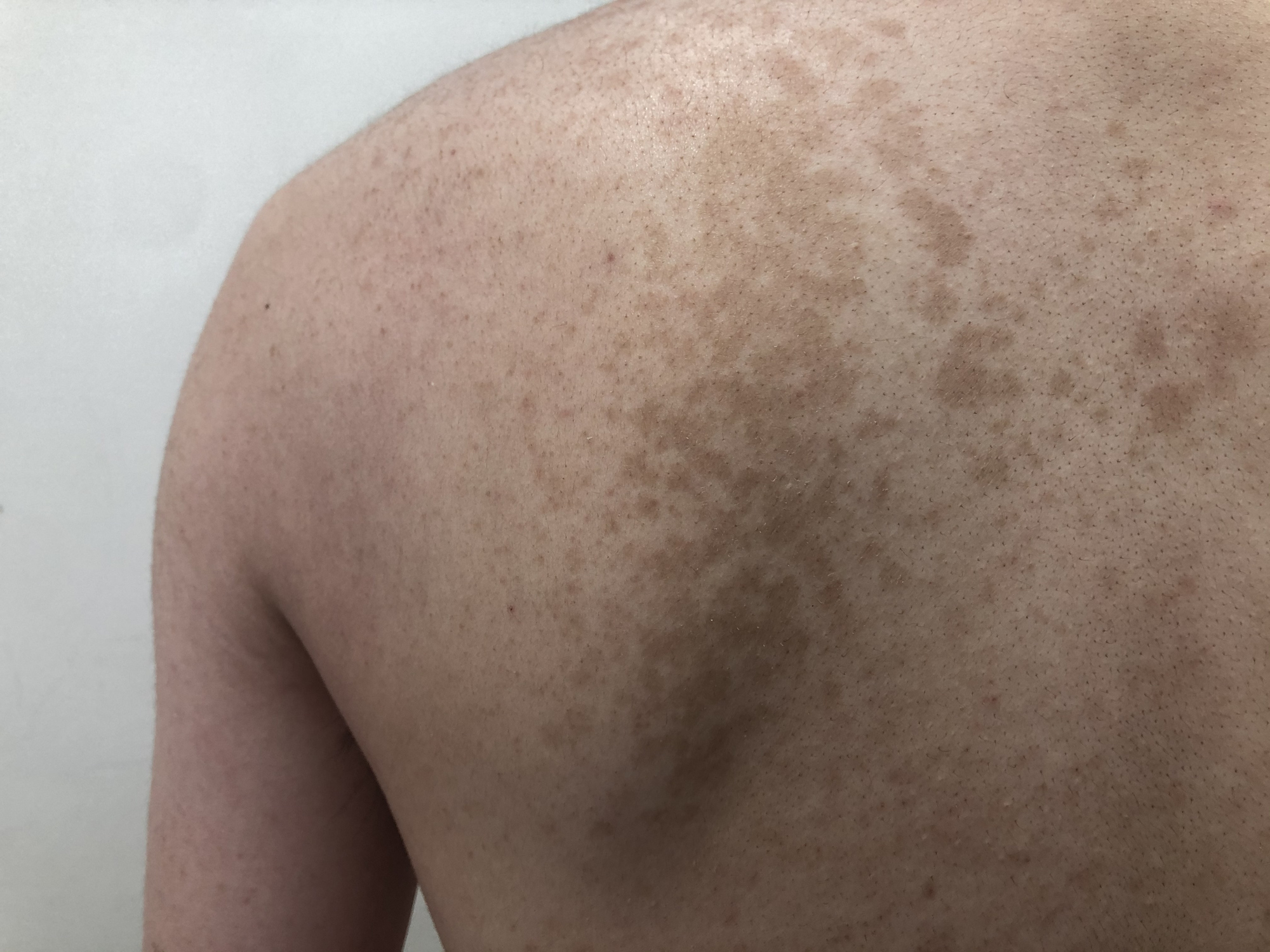 Pityriasis Versicolor What Is It And What Symptoms Does It Have