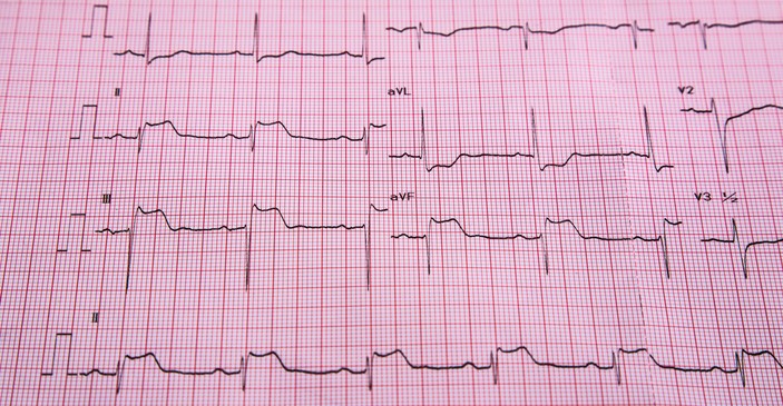 ECG - STEMI - signs of ST elevation and heart muscle infarction
