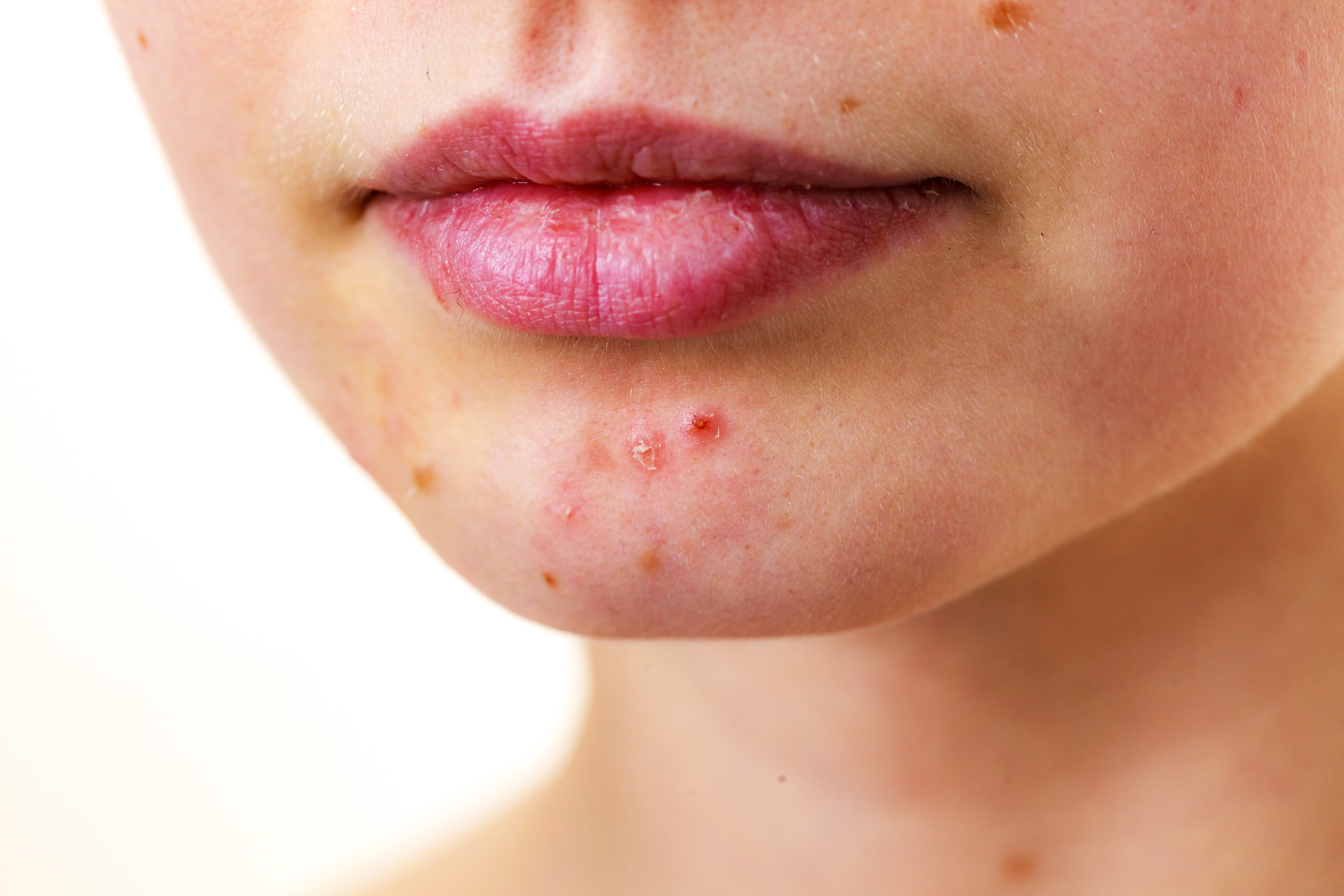 Acne on the chin of a woman - a close look.