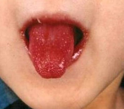 Kawasaki disease - a typical raspberry tongue
