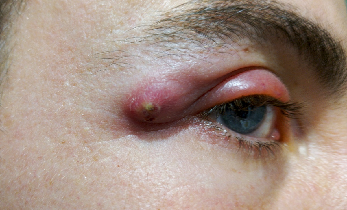 An abscess that has formed near the eye