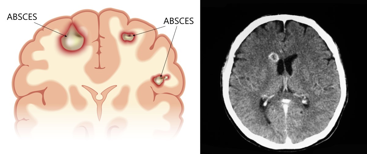 Anatomical views and CT scans of a brain abscess