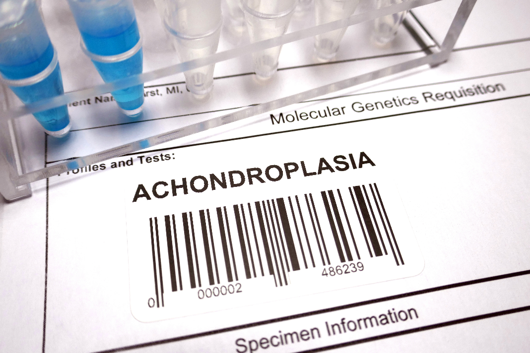 Achondroplasia: What Are The Causes, Symptoms Of Congenital Bone ...