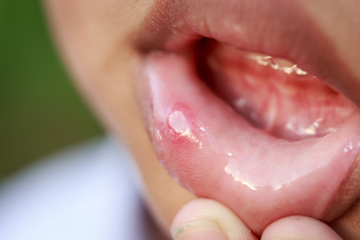 Aphthae on the inside of a child's lips