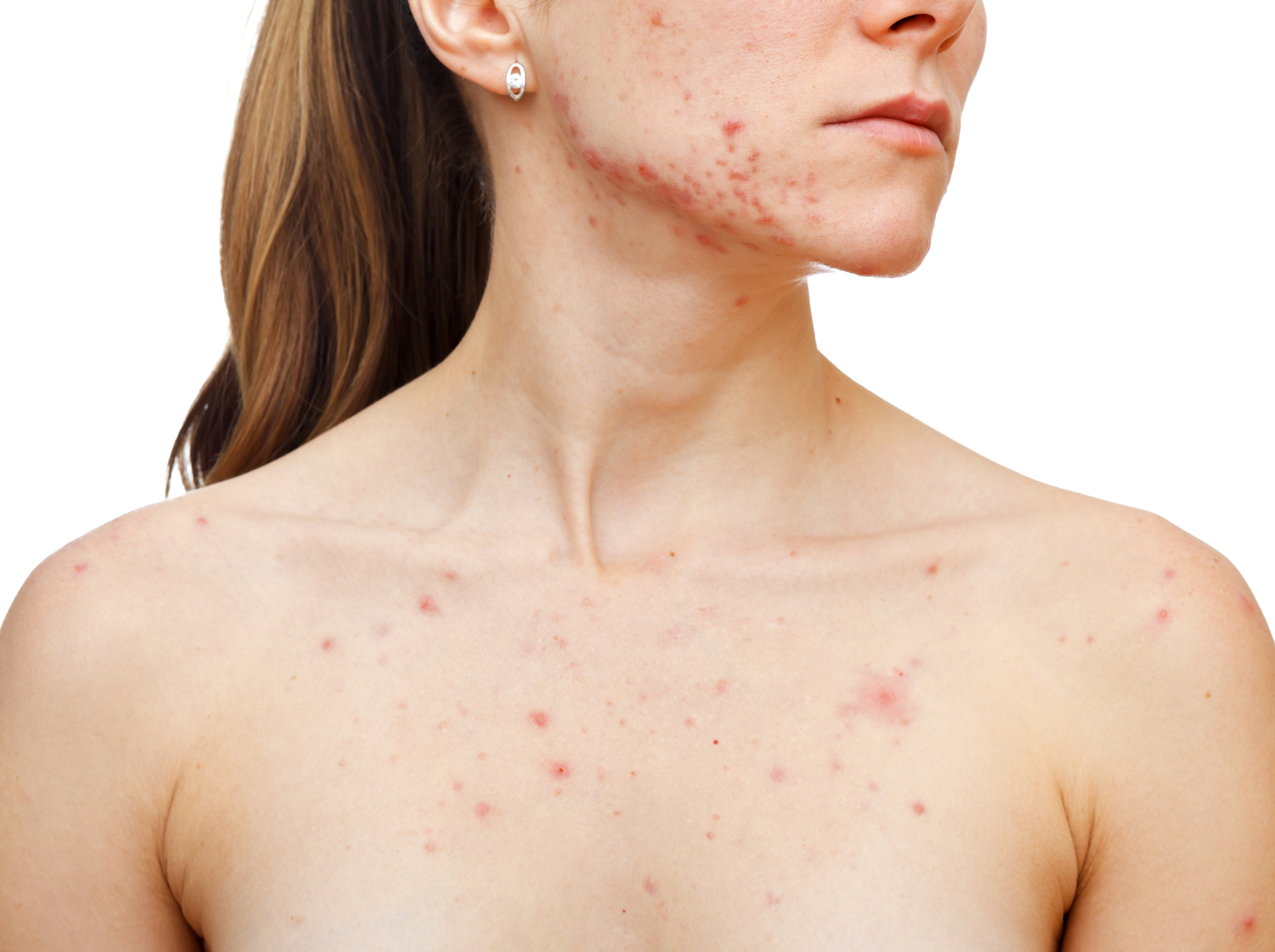 Acne on the face and chest of a woman.