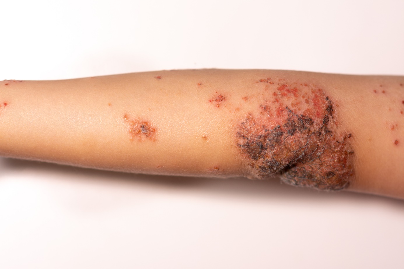 An example of what impetigo can look like