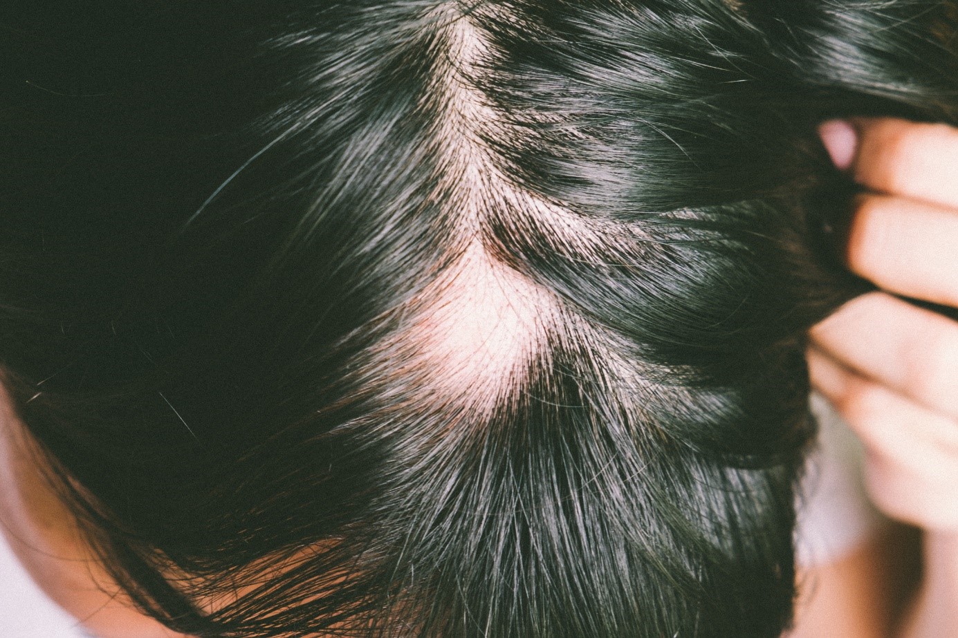 Alopecia, head, black hair, condition of excessive hair loss