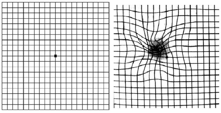 Amsler test - grid in normal vision and on the right in macular degeneration
