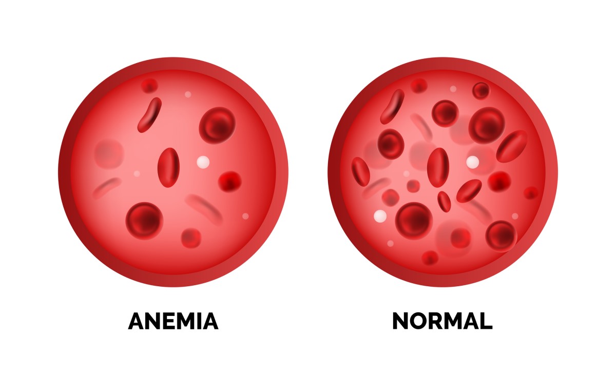 Anemia and normal blood red cell levels