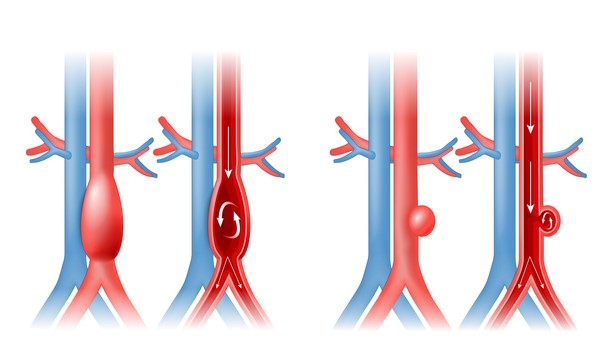 Aortic aneurysm and blood flow