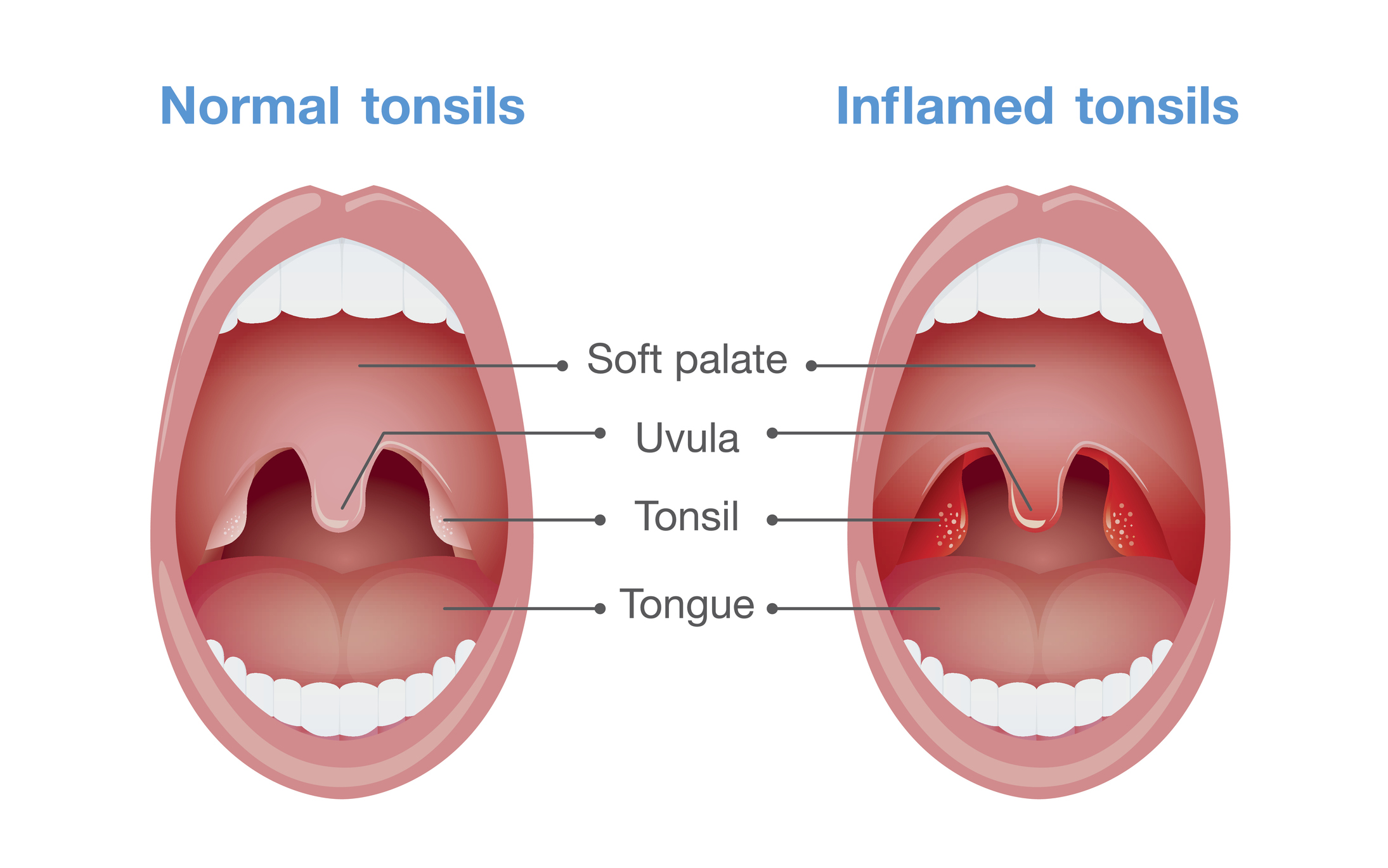 Angina - inflammation of the tonsils