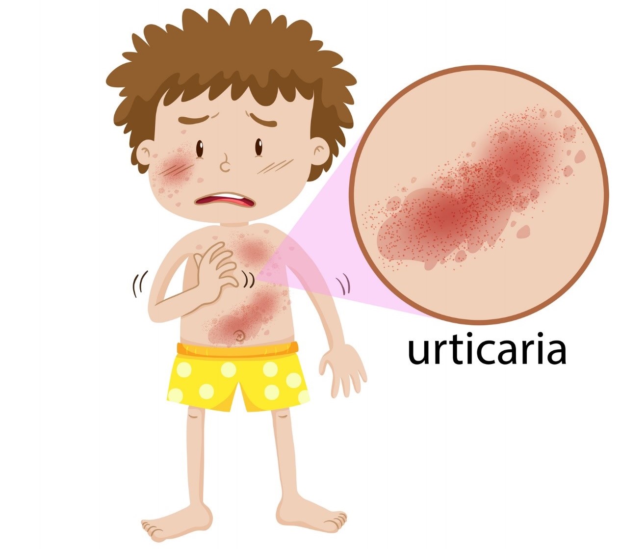 Animation - a boy with rashes all over his body, reddening of the skin, hives.
