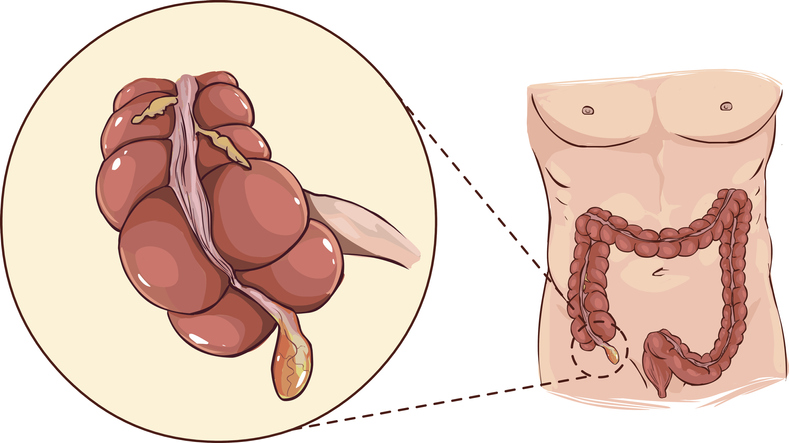 Appendix, anatomical representation at the beginning of the colon