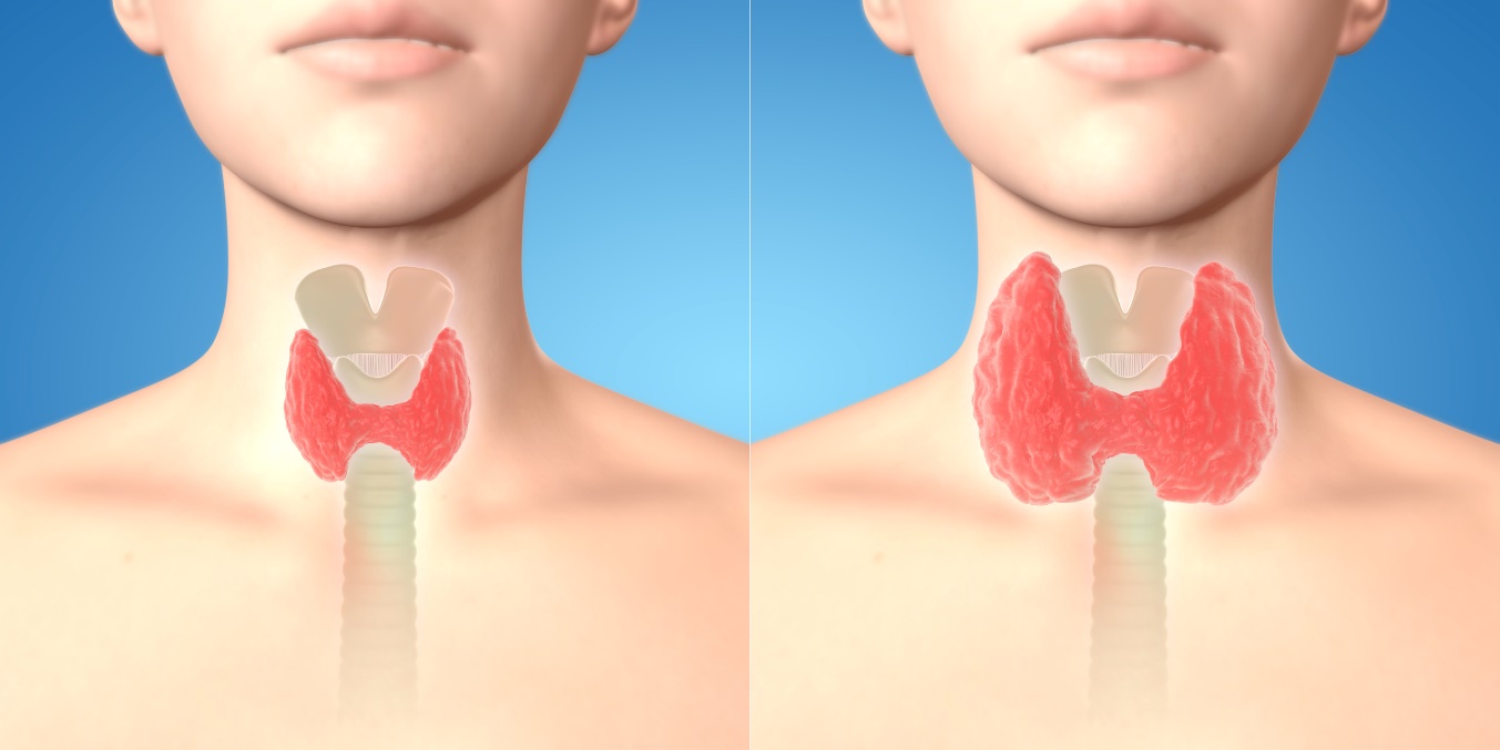 Aspect and palpation of an enlarged thyroid gland - goiter