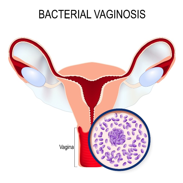 Bacterial vaginosis and Gardnerella vaginalis overgrowth