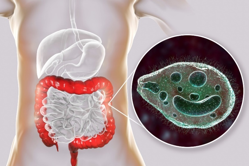 Balantidium coli - a parasite infecting the large intestine of the human digestive tract