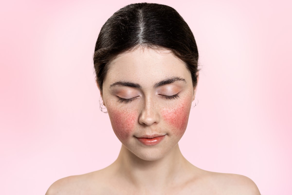 What is rosacea rosacea? What are its causes, symptoms (spots on the