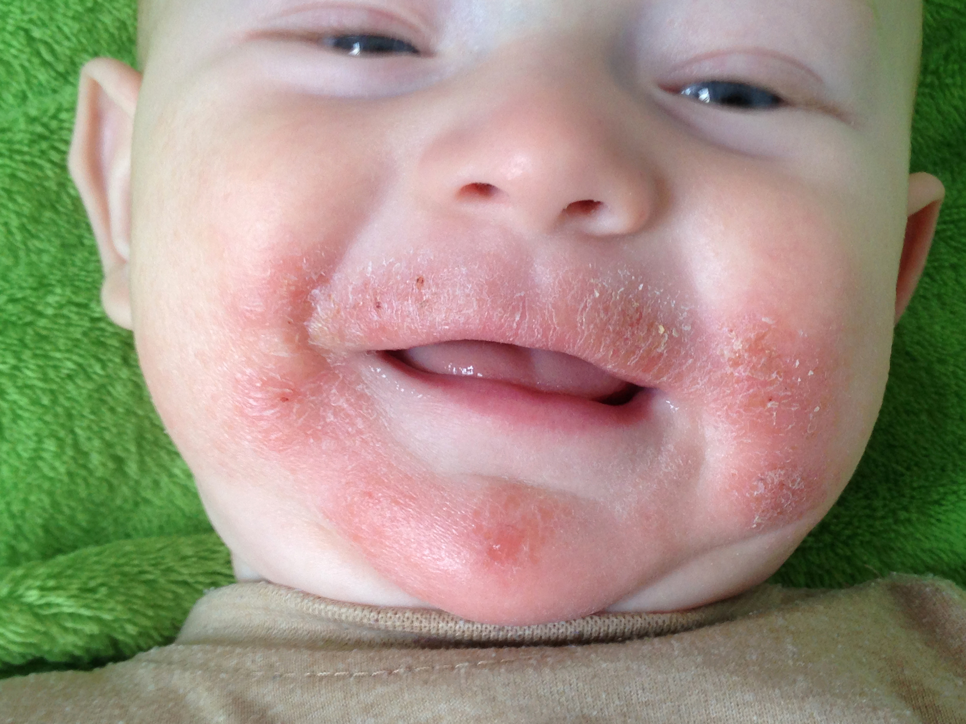 Child with atopic eczema