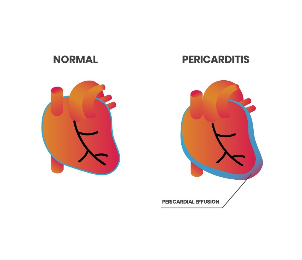 Cardiac physiology and pericarditis (pericardial effusion)