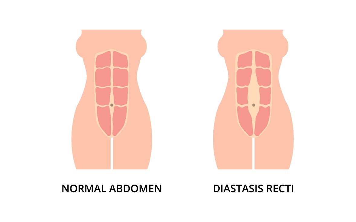 Physiological state of the abdominal muscles and diastasis (spacing) of the left and right rectus abdominis muscles from the midline of the linea alba