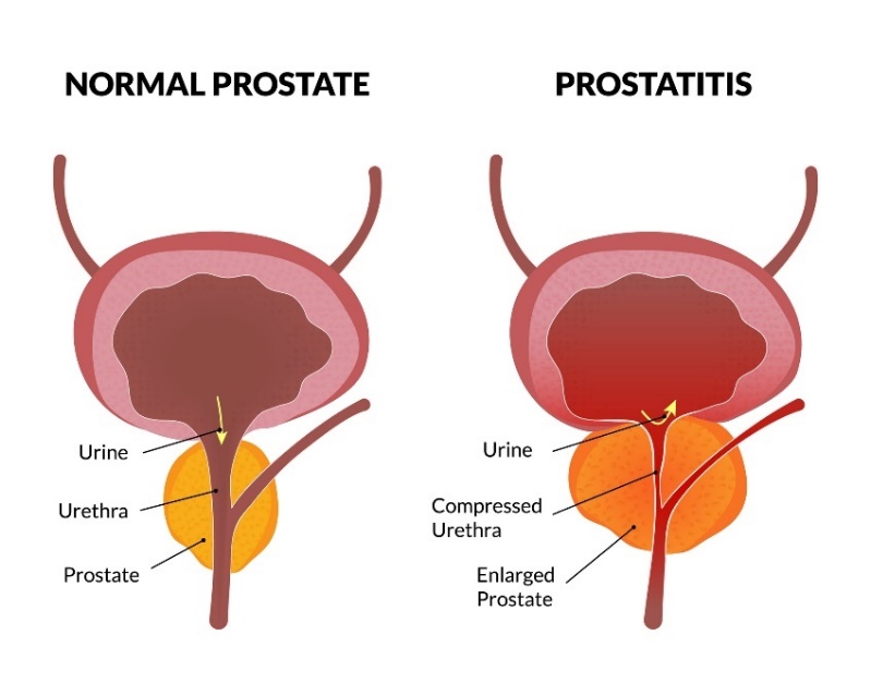 The physiological state of the prostate and prostatitis