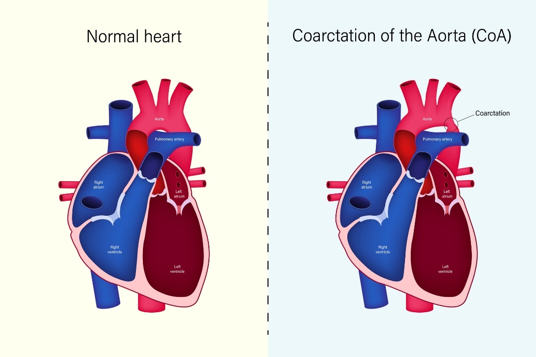 Physiological state of the heart and coarctation of the aorta (CoA)