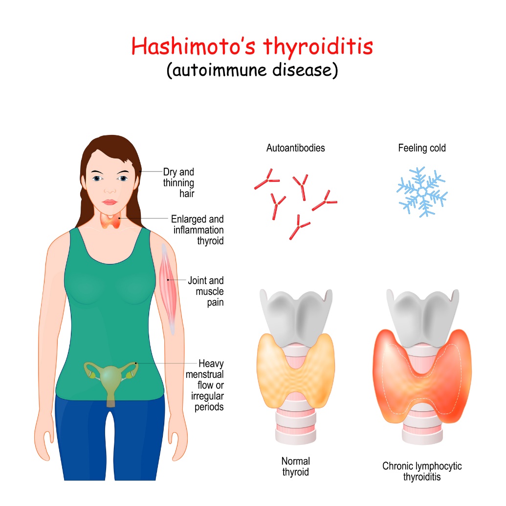 Hashimoto's thyroiditis and clinical symptoms