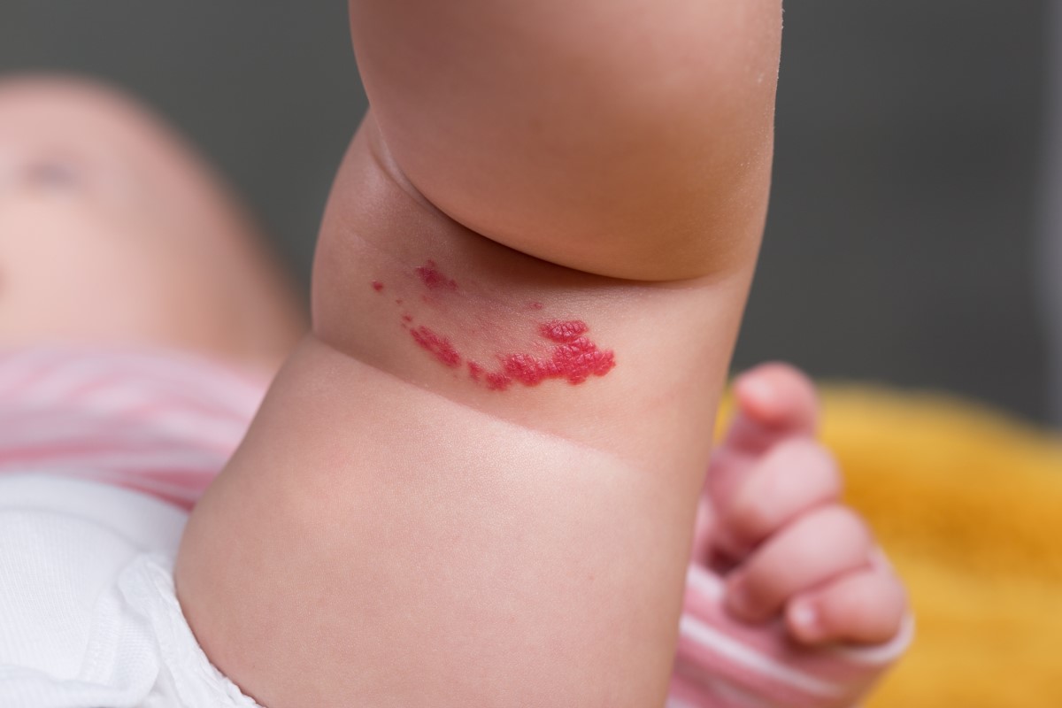 Hemangioma on the inner thigh of a child