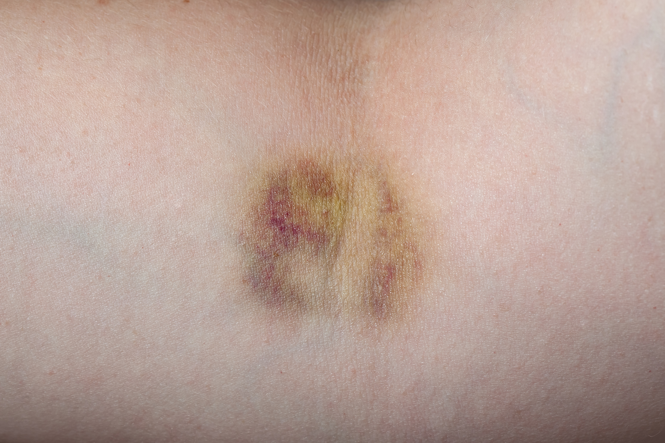 Haematoma (bruise)