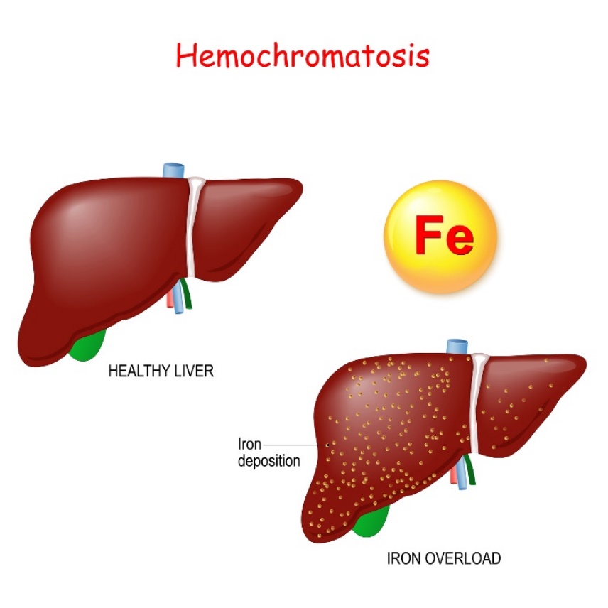 Haemochromatosis: physiology and pathology of the liver with excessive iron (Fe) deposition