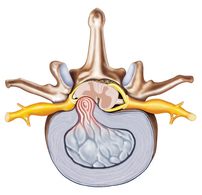 Herniated disc - anatomical representation