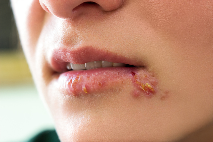 Herpes simplex on the face - lips and the corner of the mouth