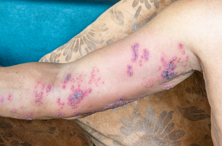 Herpes zoster on the arm