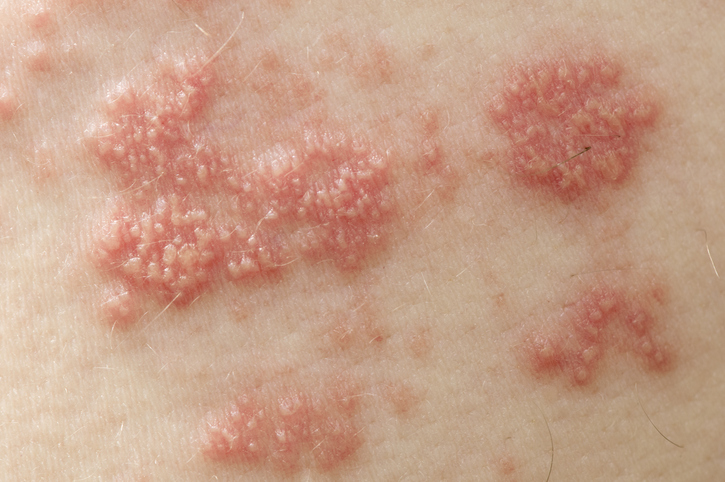 Shingles blisters on the skin, filled with virus-containing fluid
