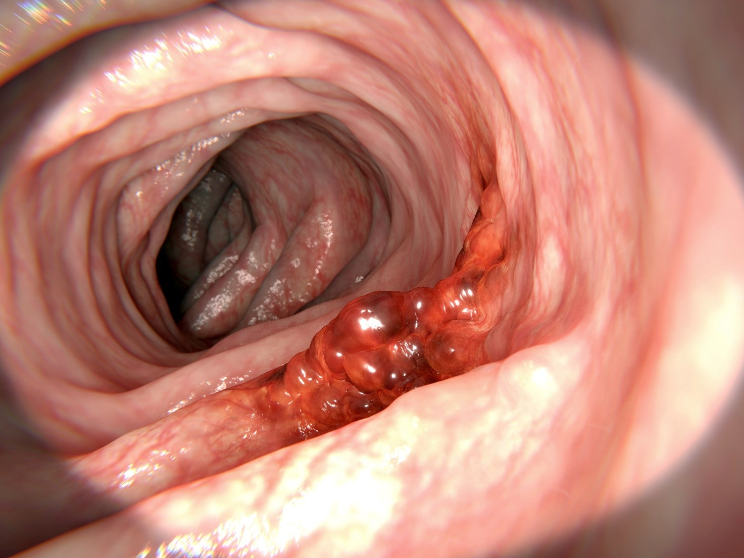 Colonoscopy and preview of findings