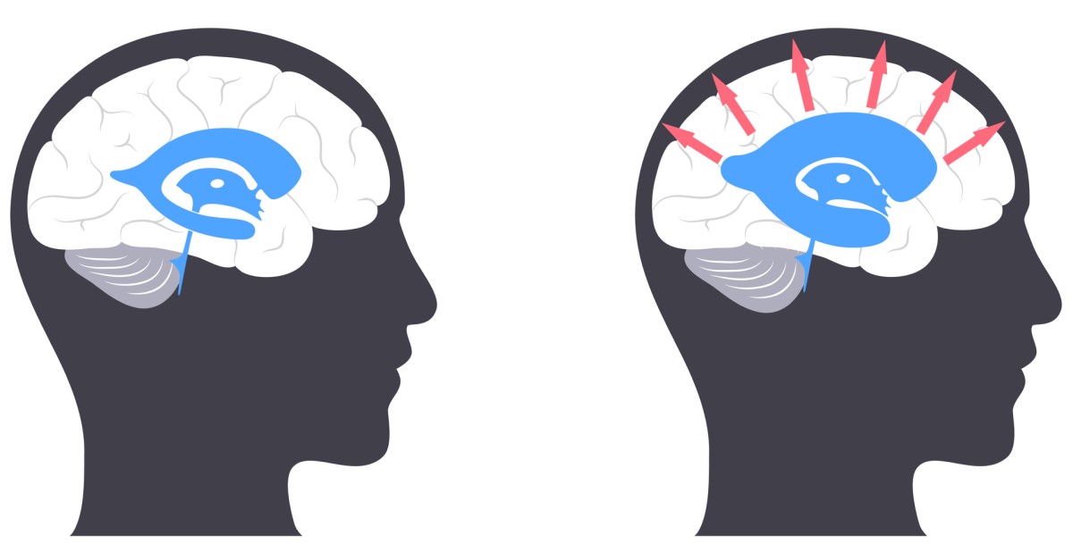 Head with brain - on the left - normal brain / on the right - head with brain with hydrocephalus, where the arrows from the centre outwards indicate enlargement of the brain ventricles and pressure on the brain tissue.