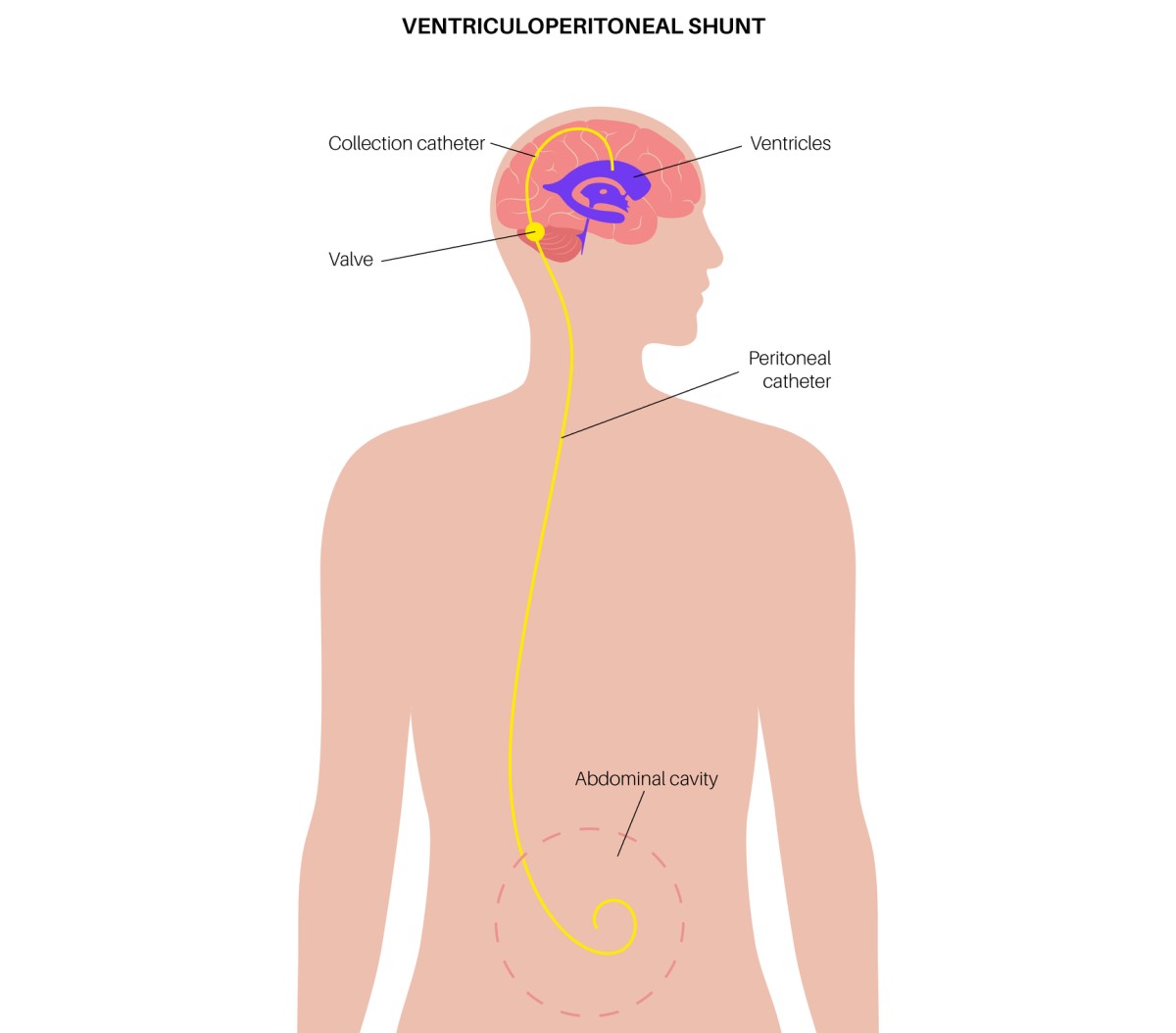 Illustration of a ventriculo-abdominal shunt that drains excess fluid from the brain into the abdominal cavity.