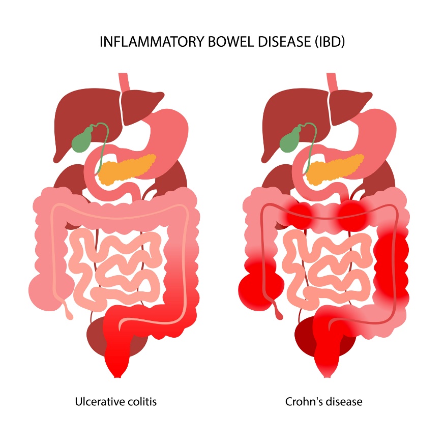 IBD: Division into ulcerative colitis and Crohn's disease according to the localization of the inflammatory reaction.