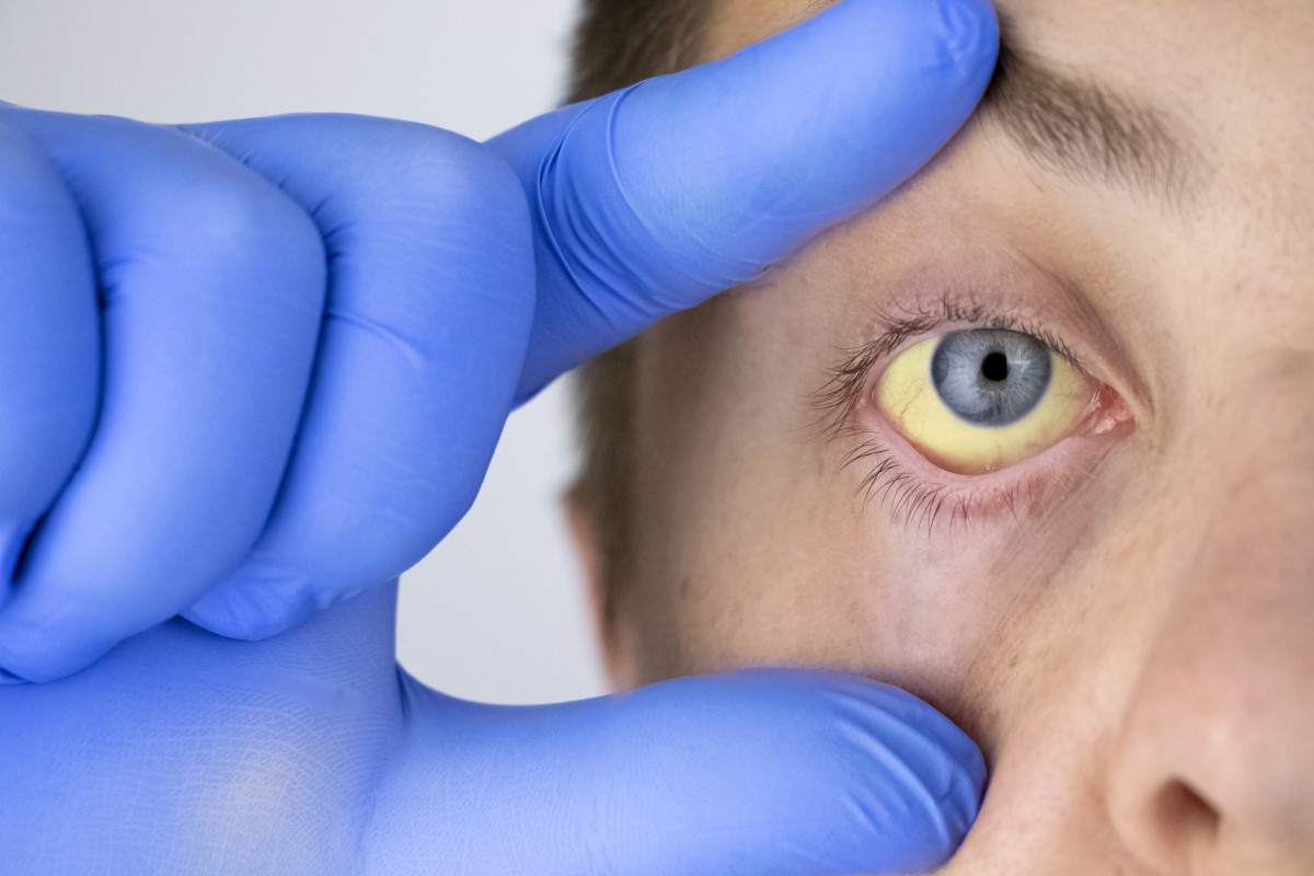 Icterus, jaundice - yellow whites of the eyes as a sign of impaired liver function.