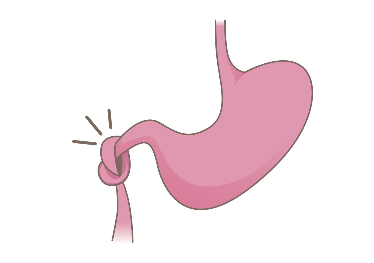 animation of strangulated intestine and intestinal obstruction - ileus of the small intestine and stomach over the intestine.