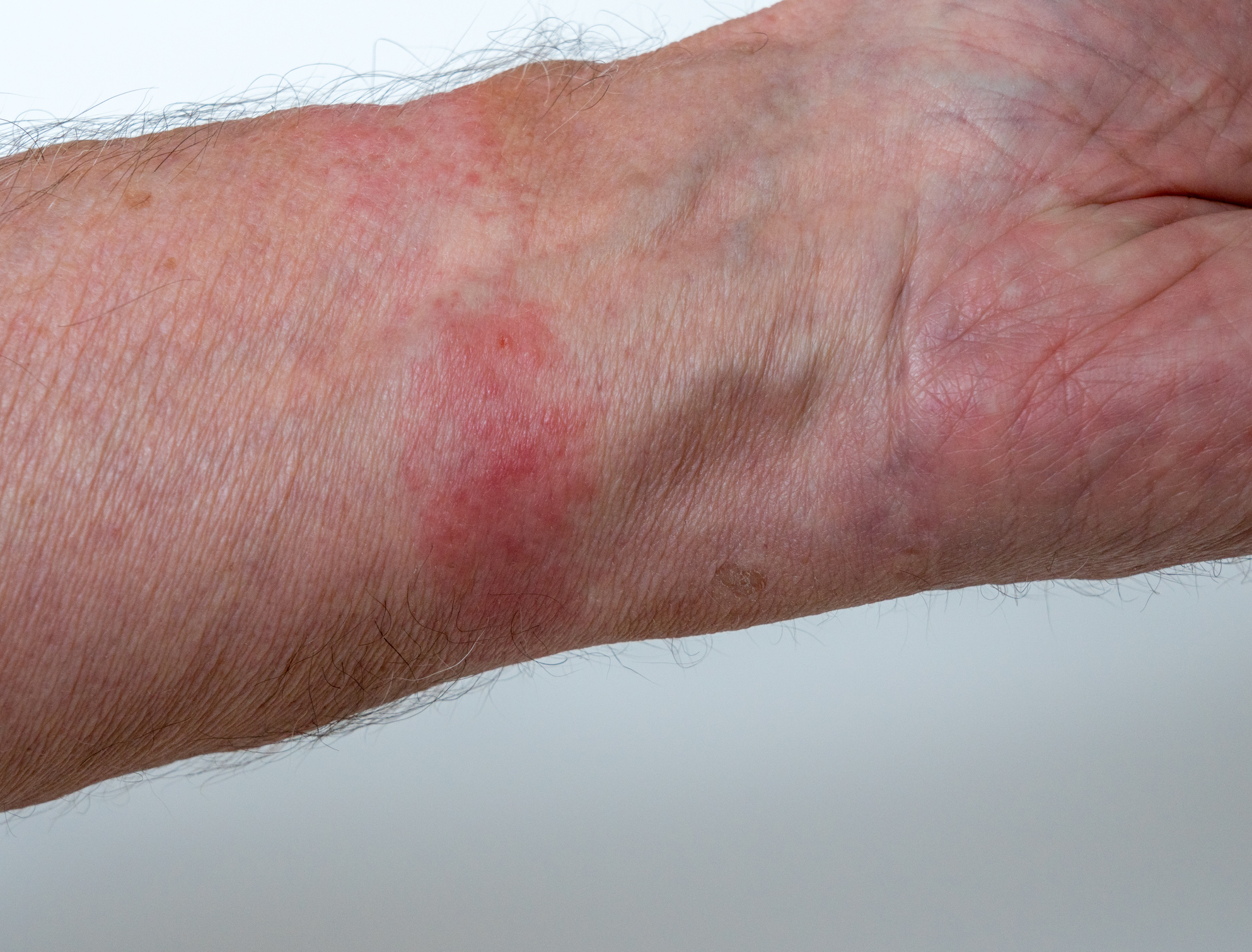 Contact dermatitis on the hands