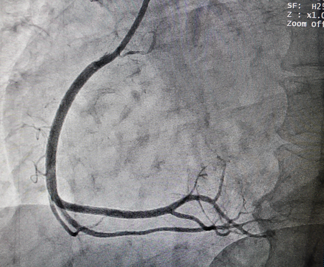 Coronary angiography - coronary artery, ie the cardiovascular system