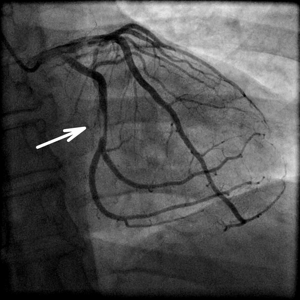 Coronary angiography and narrowing of the coronary artery