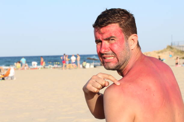 Sunburnt skin is a predisposition to skin tumours