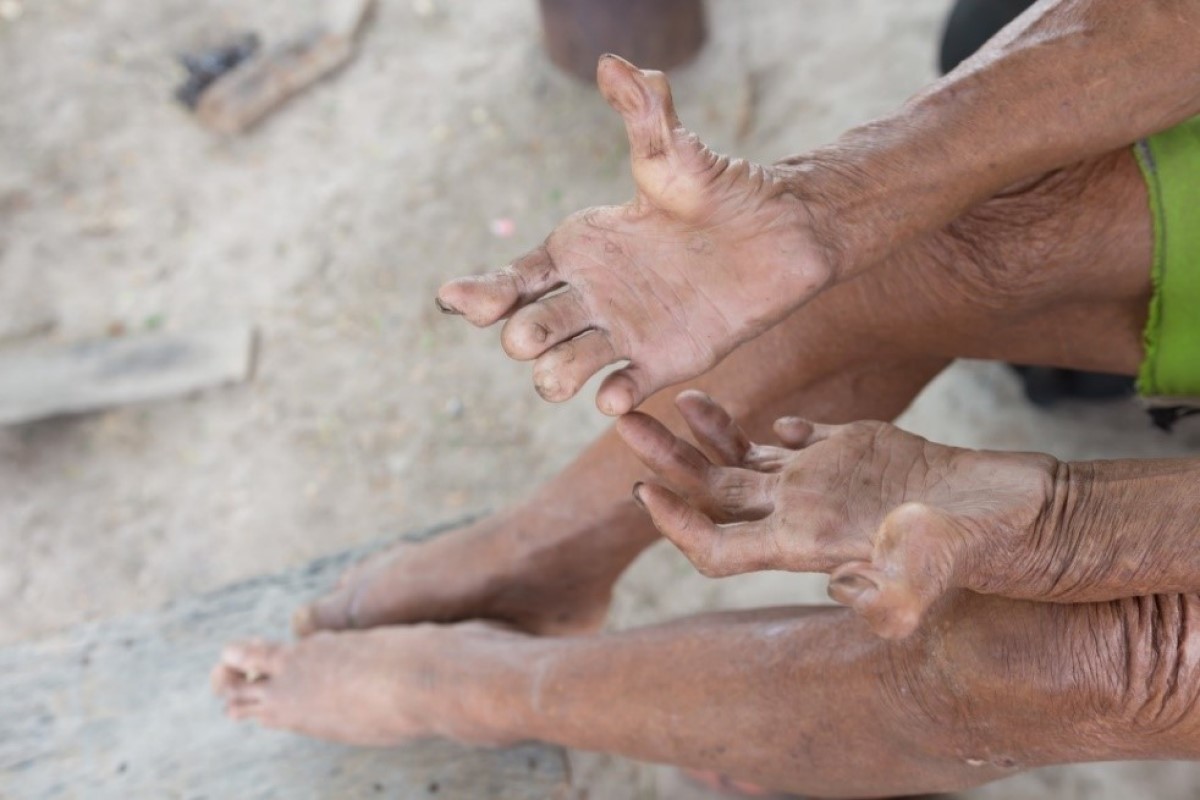Deformation of finger links - leprosy infection