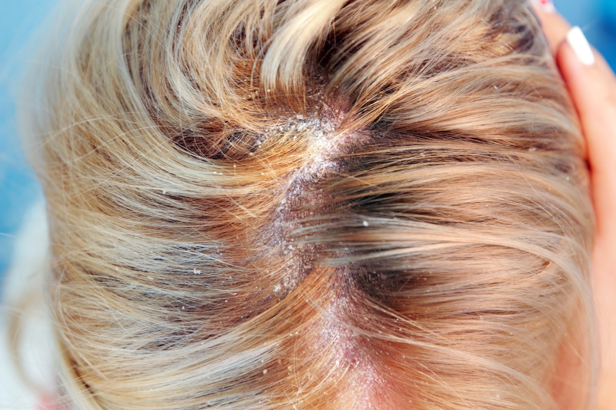 Seborrhea in the hair of a woman, dandruff in seborrheic dermatitis