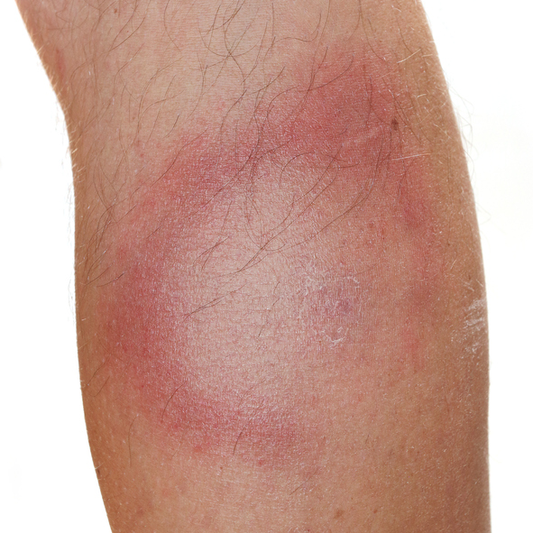A typical symptom of Lyme disease, ie migrating erythema, reddening of the skin, with a pale center