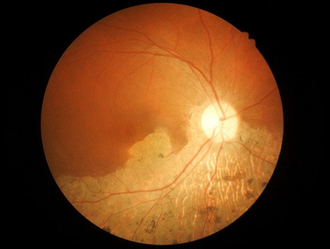 Macular degeneration during ophthalmological examination