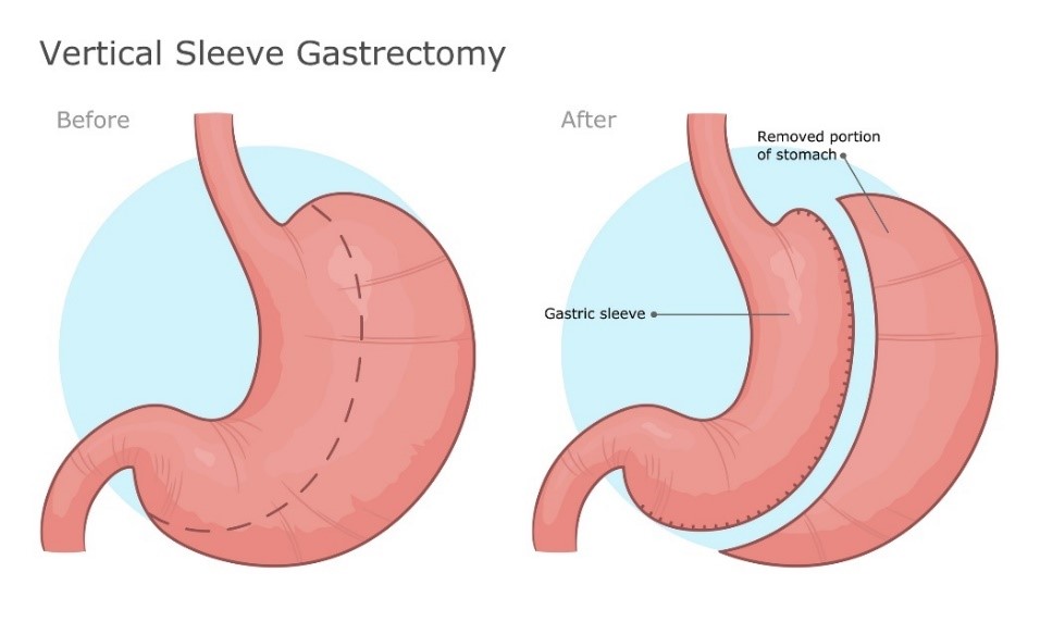 Vertical type of stomach surgery