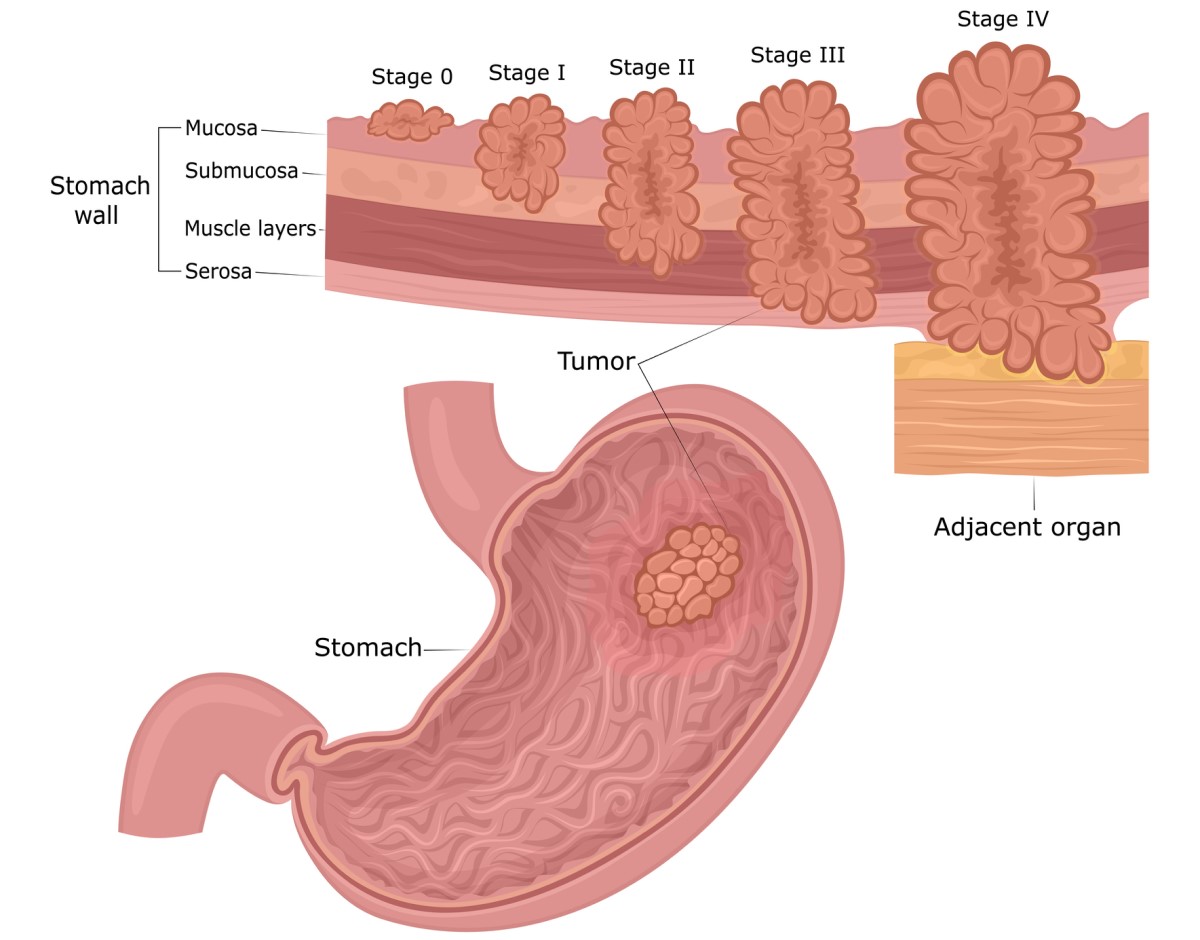 Gastric cancer: the layers of the stomach wall (mucosa, submucosa, muscle, serosa) and the stages of tumour development from the mucosa to the surroundings and organs.